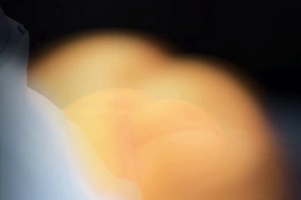 Mamoplastia de aumento: como funciona a cirurgia de prótese de silicone e o que considerar?