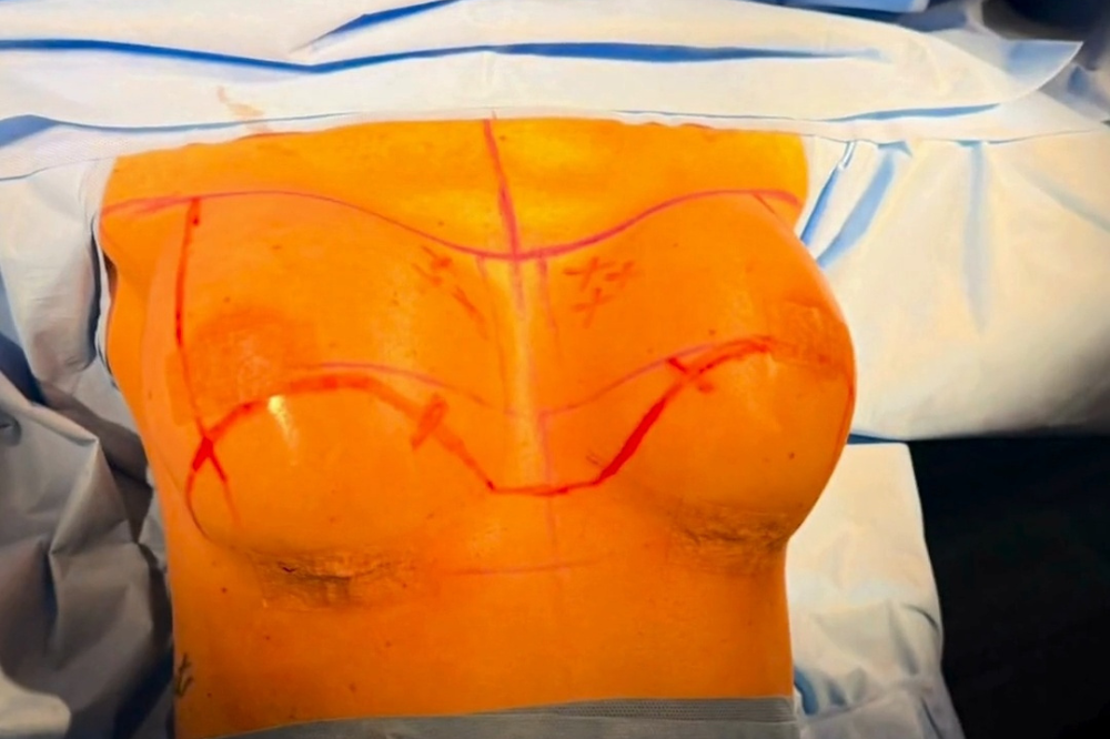 Prótese de silicone: como escolher o tamanho, o formato e o perfil mais adequados?